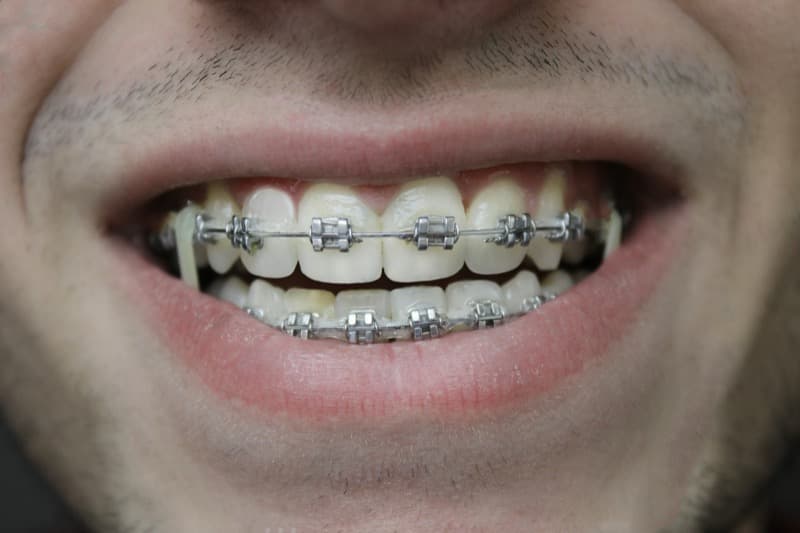 Antes - Blanqueamiento Premium